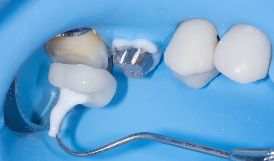 Fig. 14: Seating of the lithium disilicate (GC Initial LiSi Press) restoration. 