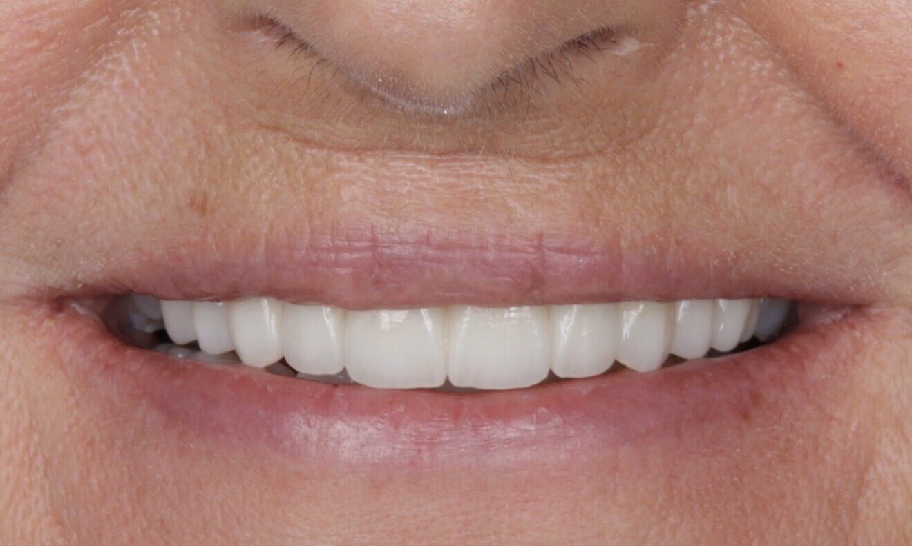 Fig. 83: The definitive restorations were placed, and occlusal adjustments were performed.