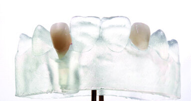 The complete digital implant  workflow