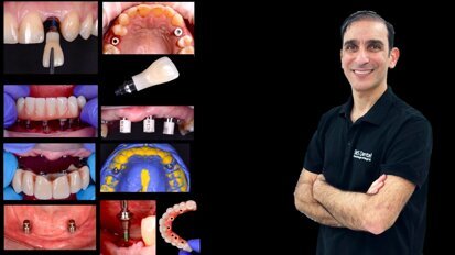 Cursos de Rehabilitación Oral, Prótesis sobre Implantes y Carillas con Ariel Labanca