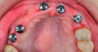 Predictable longevity of dental implants: high-quality evidence support
